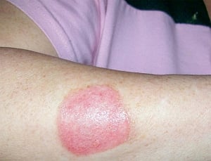 New technique to prevent burn scars