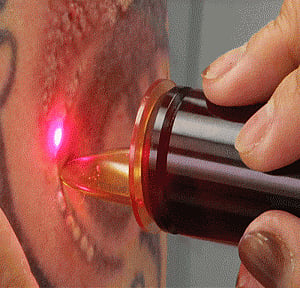 Alma-Q laser treatment is safer for tatoo removal: Doctors