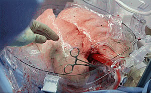 Ukrainian breathes easy after double lung-transplant