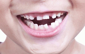 Irregular teeth linked to poor posture, balance control: study