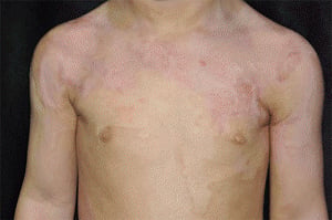 This novel method may help burn victims grow new skin