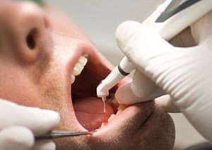 Eight dental fillings can up mercury levels in blood