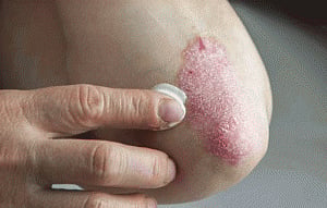 Skin defences may lead to eczema therapy: study