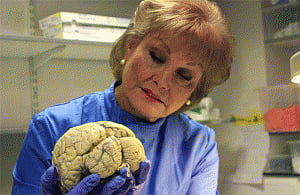 Women's better verbal memory may shield Alzheimer's risk