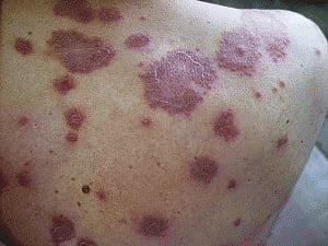 New low-cost method may provide hope for leukemia patients