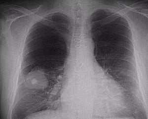 How lung cancer spread can be prevented