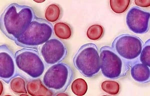 New treatment could fast-track elephantiasis elimination