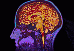low glucose in brain may trigger Alzheimer's disease: study