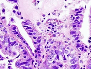 Researchers identify genetic links to gallbladder cancer
