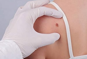 Novel therapies may halt skin cancer spread, recurrence