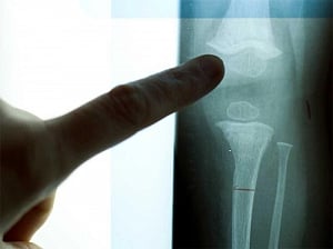 Simple water test could reduce bone disease in India