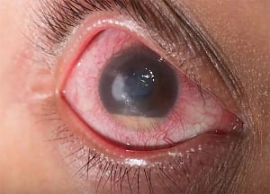 Glaucoma may be an autoimmune disease: Study