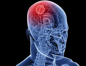 Brain tumours may occur in children with common genetic syndrome