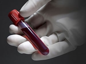 New technique developed to detect early-stage cancer tumour cells in blood, researchers claim