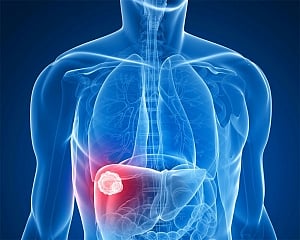 How gut microbiota can aid in early diagnosis of liver cancer