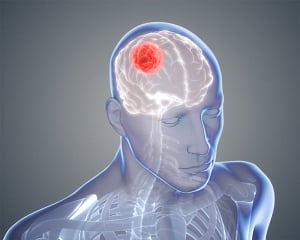 New drug shows promise in halting spread of brain cancer