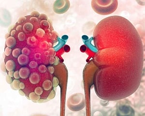 Common heartburn drug linked to kidney disease risk