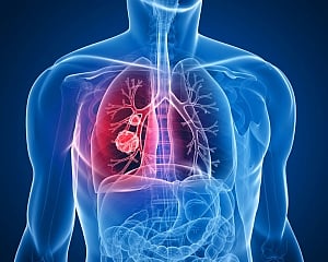 Graphene biosensor could diagnose lung cancer early
