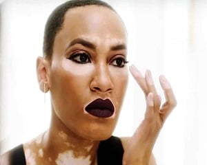 New therapy may treat vitiligo within weeks