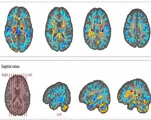 Scans on US diplomats in Cuba show 'something happened to the brains'