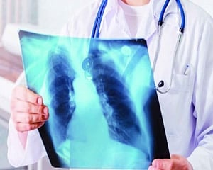 Shed TB burden