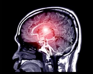Autopsy study shows Covid harms brain like Alzheimer's, Parkinson's
