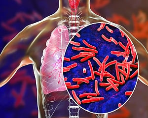 For TB elimination Direct Benefit Transfer is crucial