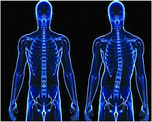 Scoliosis: A LOUSY PANDEMIC FALLOUT