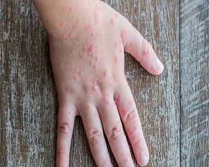 26 'tomato flu' cases in Odisha
