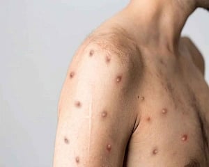 Monkeypox: Centre holds high-level meeting as India's tally climbs