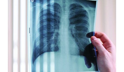 AI chest x-ray screening flags 18,000, confirms 877 TB cases in slum clusters