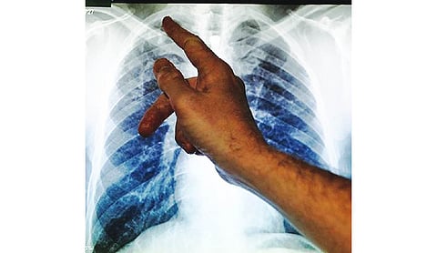 Shorter oral TB regimen found cost-effective: ICMR study