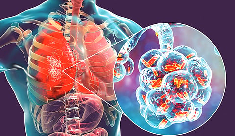 South-East Asia bears high TB burden, says WHO official