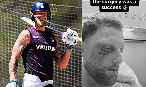 முகத்தில் ஏற்பட்ட காயம் - அறுவை சிகிச்சை செய்துகொண்ட பென் ஸ்டோக்ஸ்