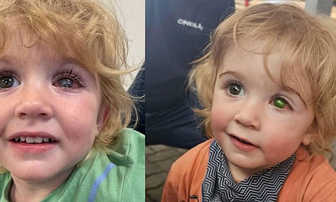 முத்தத்தால் குழந்தைக்கு கண் பார்வை பறிபோன பரிதாபம்