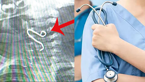 ஈரோட்டில் ஒரு வயது குழந்தையின் தொண்டையில் சிக்கிய இரும்பு கம்பி அகற்றம் - அரசு மருத்துவர்கள் சாதனை