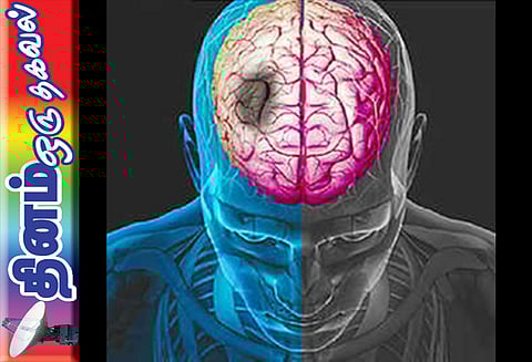 தினம் ஒரு தகவல் : பக்கவாதத்திற்கான காரணங்கள்