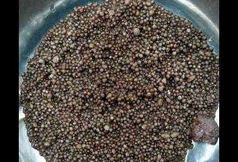 சிறுநீரகத்தில் 3,000 கற்கள் மருத்துவர்கள் அதிர்ச்சி