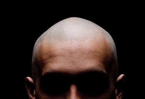 சந்தனத்தை முகர்வதன் மூலம் வழுக்கை தலைக்கு சிகிச்சை ஆராய்ச்சியில் கண்டு பிடிப்பு