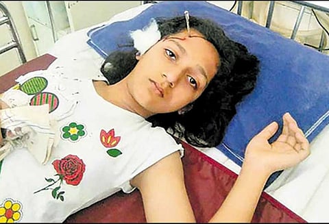 மராட்டியத்தில் சிறுமியின் தலையில் புகுந்த ஆணி - அறுவை சிகிச்சை மூலம் அகற்றம்