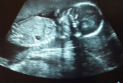 26 வார கருவை கலைக்க அனுமதி கோரி மும்பை ஐகோர்ட்டில் சிறுமி மனு