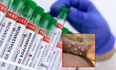 குரங்கு அம்மை பாதிப்பு: காங்கோ-9, நைஜீரியாவில் முதல் பலி