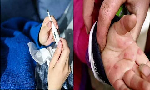 தக்காளி காய்ச்சல் பாதிப்பு என அழைப்பது சரியா? தவறா? நிபுணர்கள் பதில்