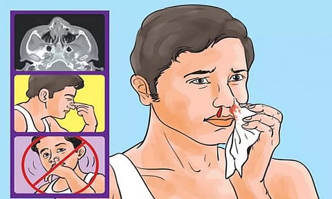 குழந்தைகளுக்கு மூக்கில் இருந்து ரத்தம் வர காரணங்கள்