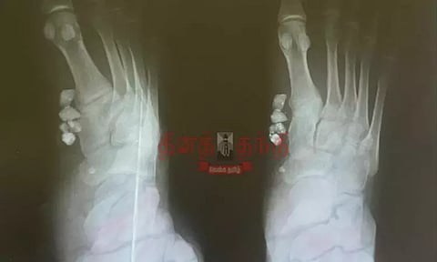 சாலை விபத்தில் காயமடைந்தவருக்கு கணுக்காலில் கற்களுடன் தையல் போட்ட அரசு மருத்துவமனை ஊழியர்கள்...!