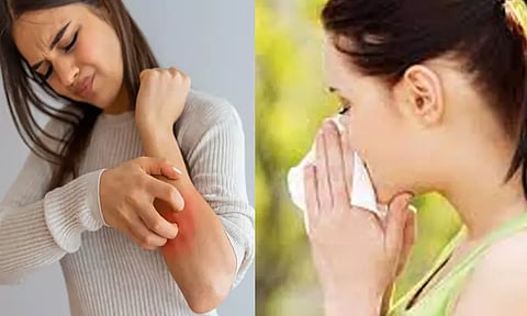 45 கோடி இந்தியர்கள் வெவ்வேறு ஒவ்வாமைகளால் அவதி - மருத்துவ நிபுணர்கள்