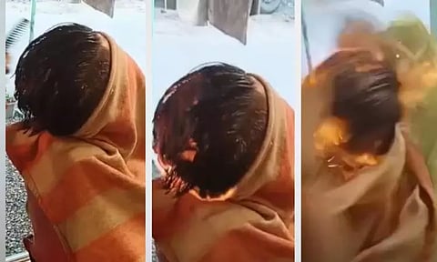 பயர் ஹேர்கட் செய்து கொண்டவர் உடல் முழுவதும் தீ பரவி ஆபத்தான நிலையில் சிகிச்சை