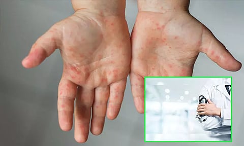 மராட்டியத்தில் அம்மை நோய்க்கு 2-வது உயிரிழப்பு பதிவு; 126 குழந்தைகளுக்கு பாதிப்பு