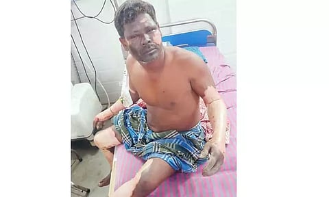 திண்டிவனம் அருகே நாட்டுவெடி வெடித்து விவசாயி படுகாயம்