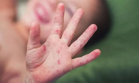 மும்பையில் தட்டம்மை நோய் பரவலை கட்டுப்படுத்த நடவடிக்கை தீவிரம்...!